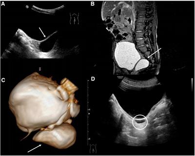 Zinner syndrome in pediatric patients: rare disease leading to challenging management